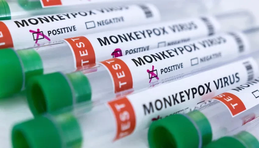  Infectologista de Lagoa da Prata esclarece dúvidas sobre a monkeypox, a ‘varíola dos macacos’